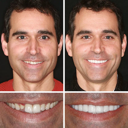 ⏰Ends Today: 75% OFF! 🦷DarkFairy™ Medical Full Denture with Strong Suctiond Custom-Fit Full Functional Dentures🦷