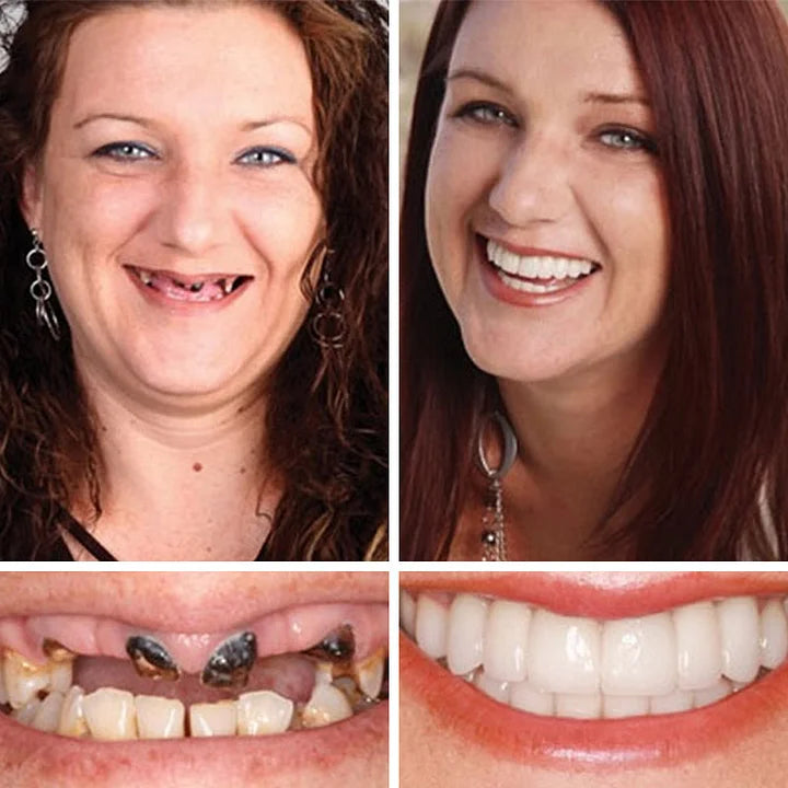 ⏰Ends Today: 75% OFF! 🦷DarkFairy™ Medical Full Denture with Strong Suctiond Custom-Fit Full Functional Dentures🦷