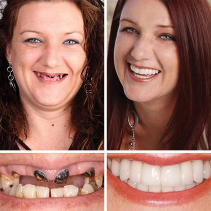 ⏰Ends Today: 75% OFF! 🦷DarkFairy™ Medical Full Denture with Strong Suctiond Custom-Fit Full Functional Dentures🦷